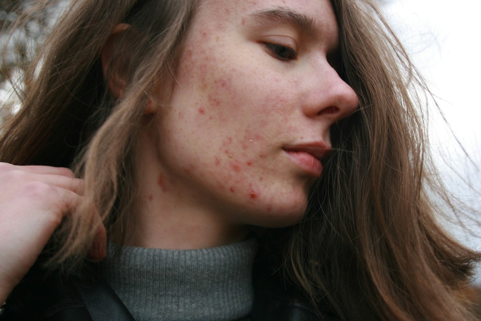 Understanding and Treating Acne: A Comprehensive Guide