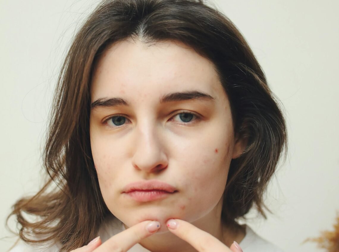 Differin Acne Treatment Gel, 30 Day Supply, Retinoid Treatment for Face with 0.1% Adapalene, Gentle Skin Care for Acne Prone Sensitive Skin, 15g Tube (Packaging May Vary)